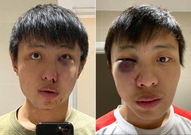 疑因疫情受歧视，新加坡学生伦敦街头被打成重伤